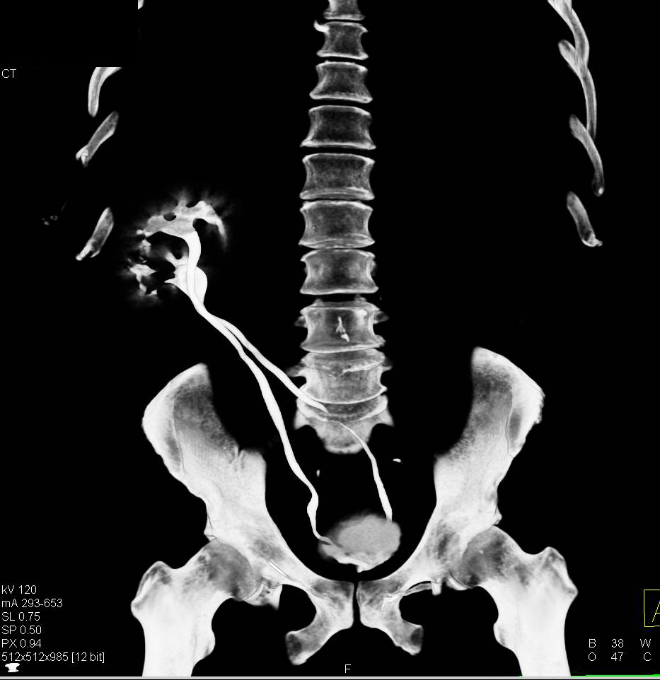 Duplicated Collecting System with Two Ureters and a Solitary Kidney - CTisus CT Scan