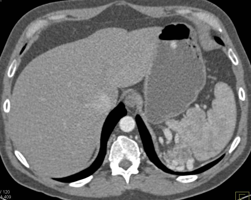 Clear Cell Renal Cell Carcinoma with Neovascularity and Perirenal Collaterals - CTisus CT Scan