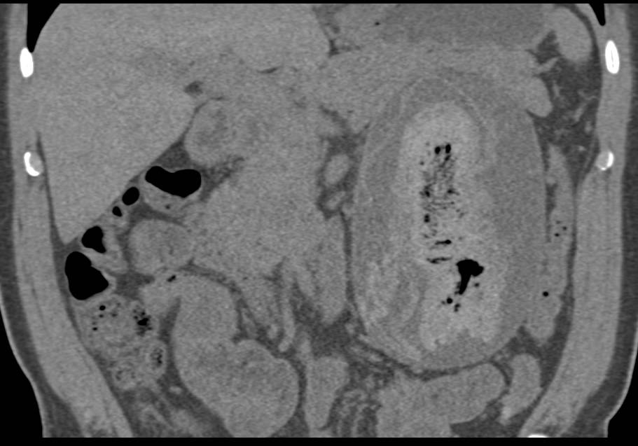 Retained Towel Near Surgical Bed Simulates and Abscess - CTisus CT Scan