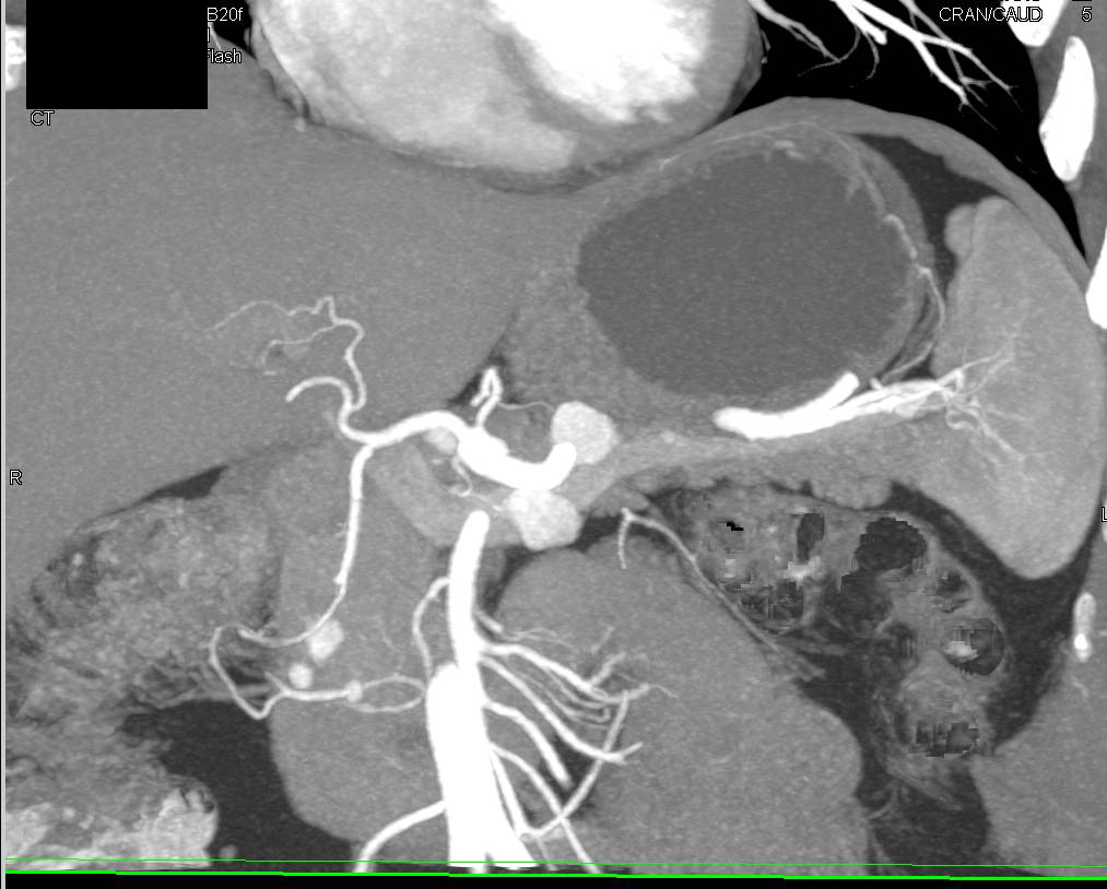 Renal Cell Carcinoma Metastatic to the Pancreas with Vascular Metastases - CTisus CT Scan