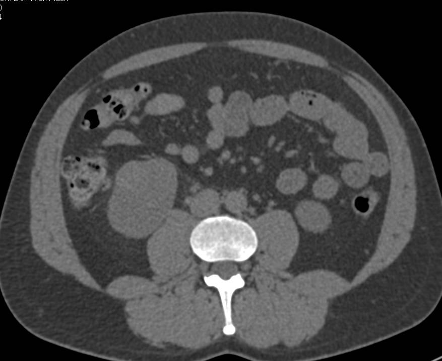 3 cm Right Renal Cell Carcinoma that is easy to miss - CTisus CT Scan
