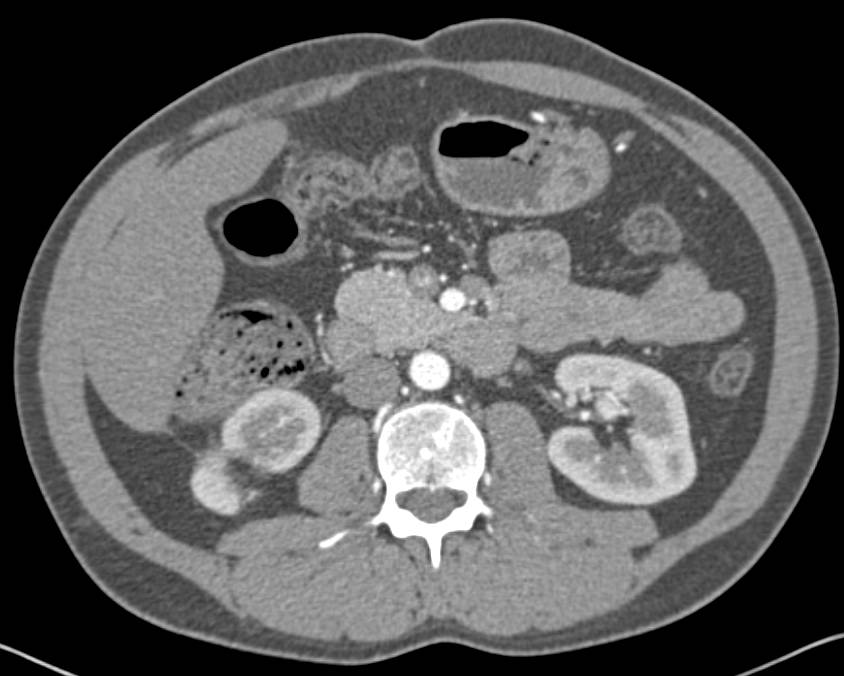 Focal Scarring Right Kidney  Simulates a Mass. Hemangioma Liver also seen - CTisus CT Scan