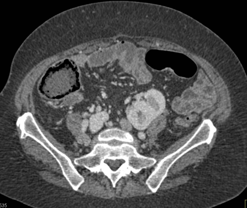 Pelvic Kidneys - CTisus CT Scan