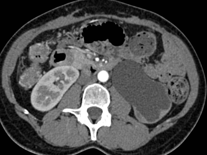 Ureteropelvic Junction (UPJ) Left Kidney with Dilated Left Renal Pelvis - CTisus CT Scan
