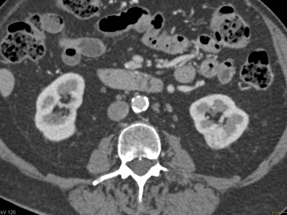 Subtle Vascular Left Renal Cell Carcinoma Easy to Miss on Arterial Phase Imaging. Patient Also Has A pessary in Place. - CTisus CT Scan