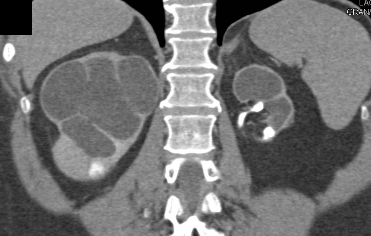 Atrophic Left Kidney and Dilated Calyx in Right Kidney with Stone Disease. Could be a Form of Focal Xanthogranulomatous Pyelonephritis (XGP). - CTisus CT Scan