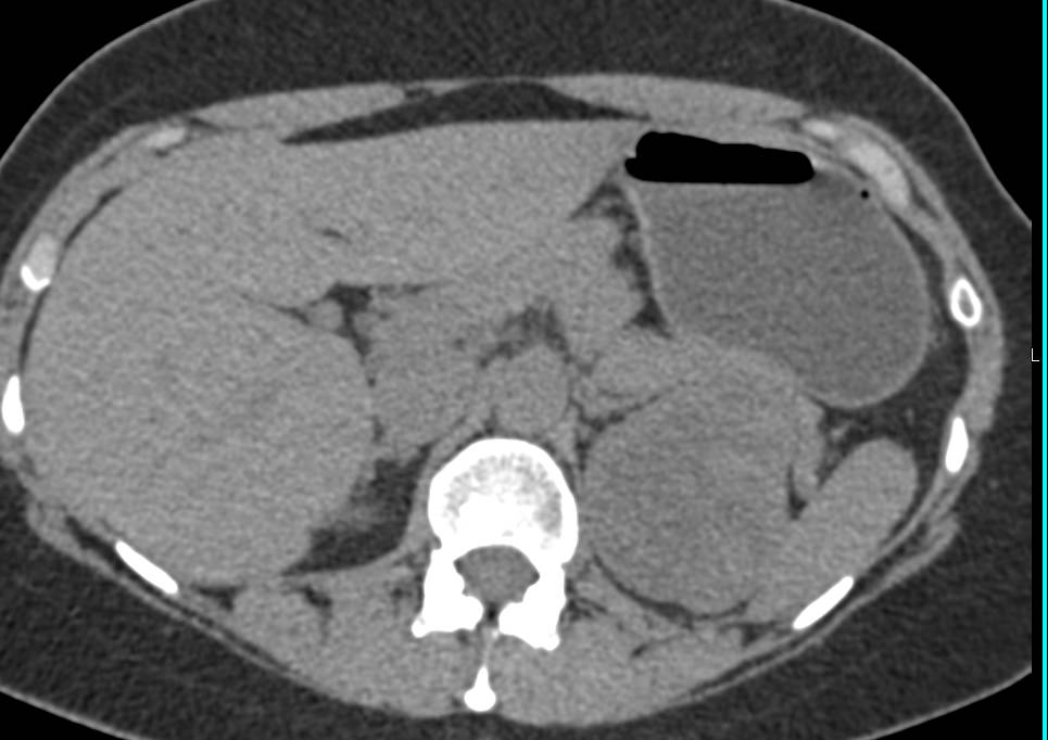 Atypical Oncocytoma Upper Pole Left Kidney - CTisus CT Scan