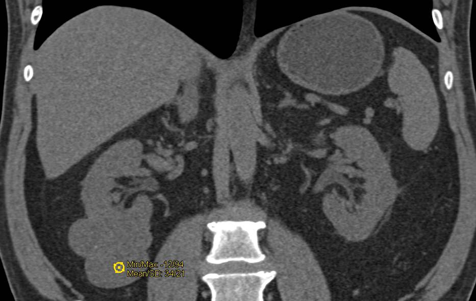 Bosniak II Right Renal Cyst - CTisus CT Scan