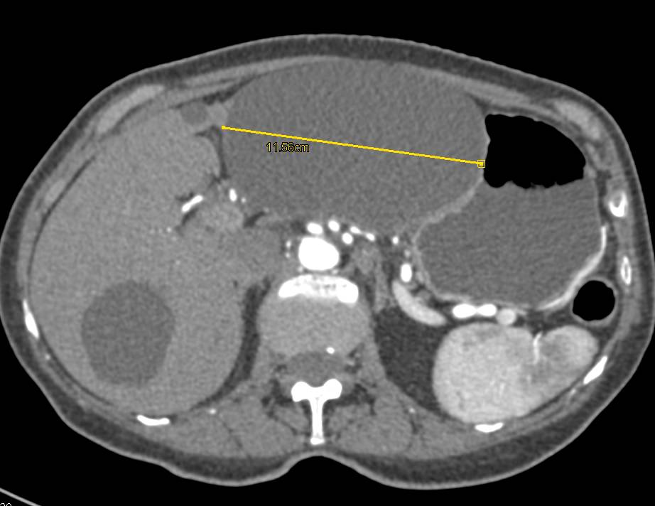 Large Pancreatic Pseudocyst - CTisus CT Scan