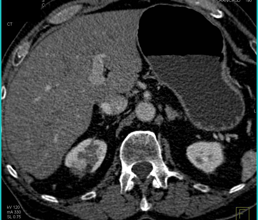 Scarring Upper Pole Right Kidney - CTisus CT Scan