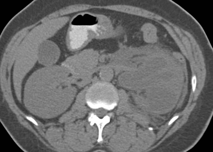 Left Hydronephrosis due to Left Ureteral Calculus - CTisus CT Scan