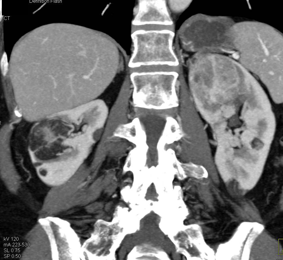 Multiple Renal Angiomyolipomas in Different Appearances. Lesion Upper Pole Left Kidney Looks like an RCC (renal cell carcinoma) - CTisus CT Scan