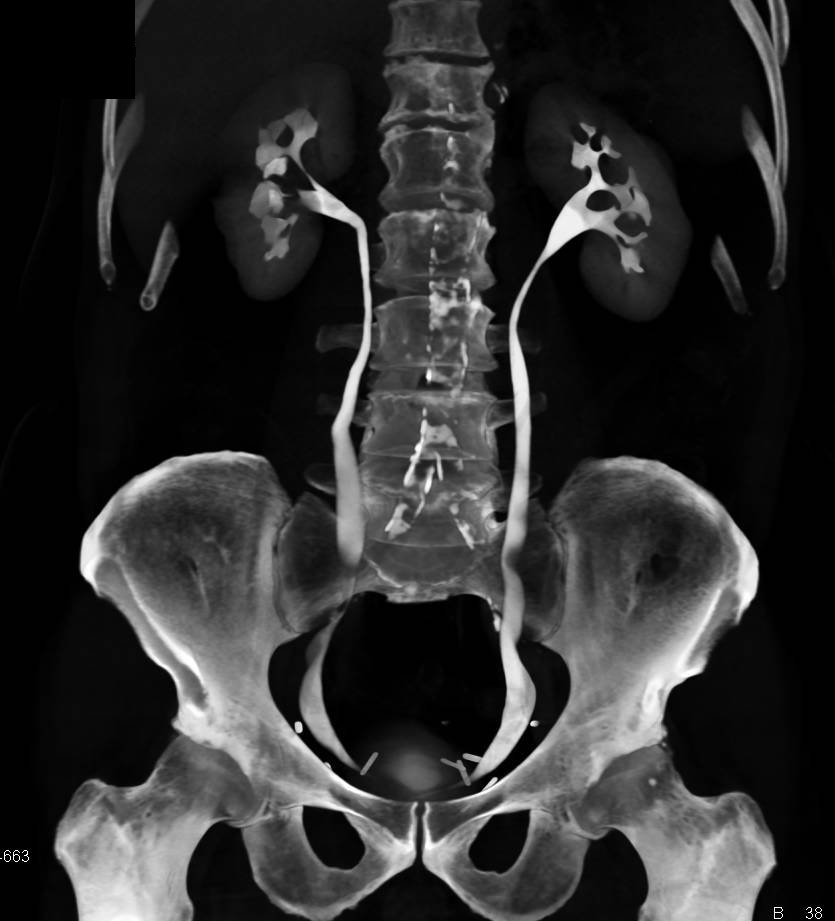 CT Urogram s/p Prostatectomy Without Complication - CTisus CT Scan