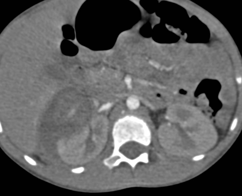 Right Renal Laceration with Multiple Phases. Delayed Phase Nicely Shows the Extravasation from the Collecting System - CTisus CT Scan
