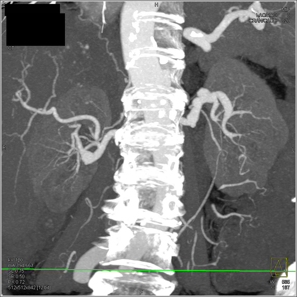 Fibromuscular Dysplasia of the Left Renal Artery (FMD) - CTisus CT Scan