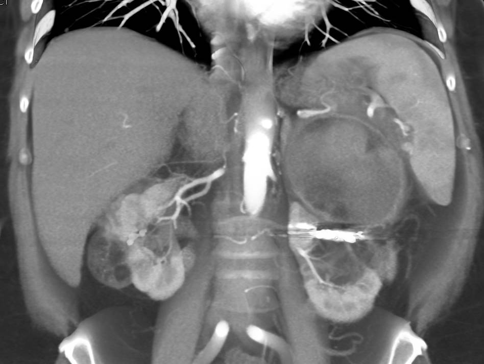 Multiple Bilateral Renal Angiomyolipomas with an Acute Bleed in the Mass Upper Pole Left Kidney - CTisus CT Scan