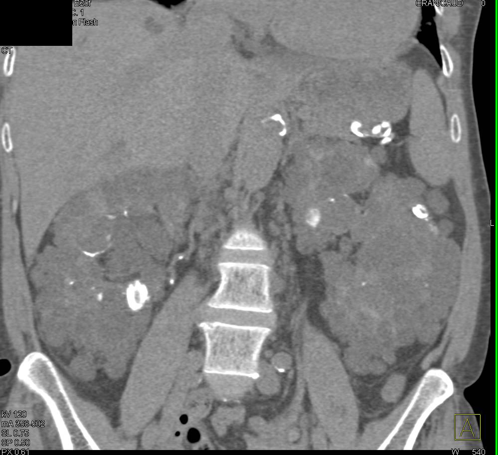 Polycystic Kidney Disease (PCKD) with high Density Cysts and Renal Calcifications - CTisus CT Scan