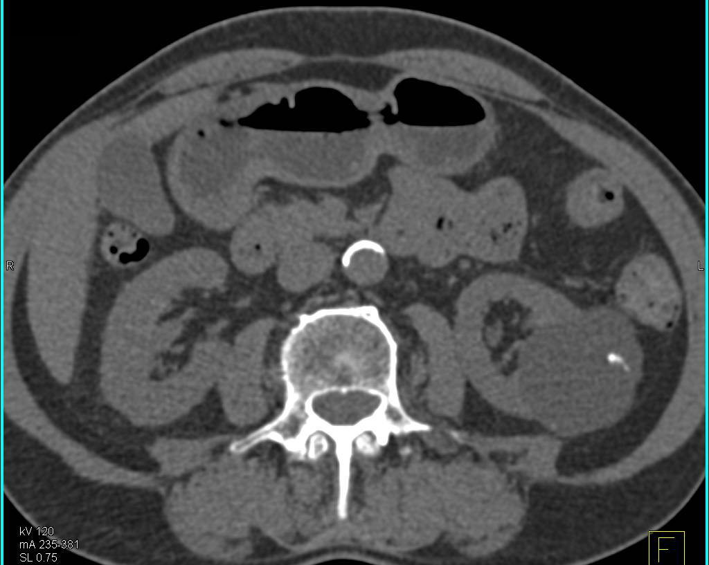 Bosniak Cyst II with Septation and Calcification - CTisus CT Scan