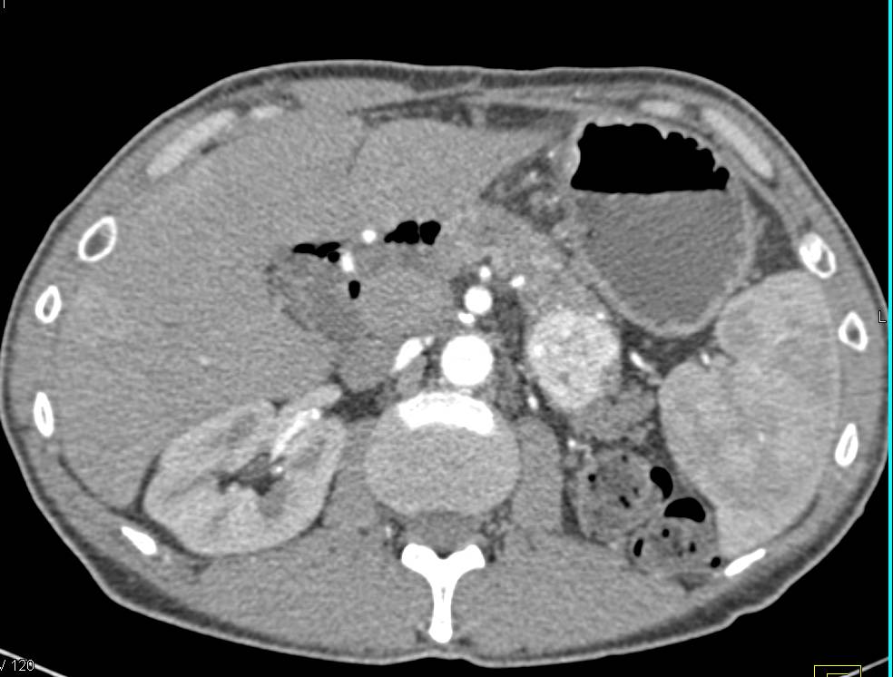 Left Nephrectomy for Renal Cell Carcinoma with Metastases to the Pancreas and Liver - CTisus CT Scan