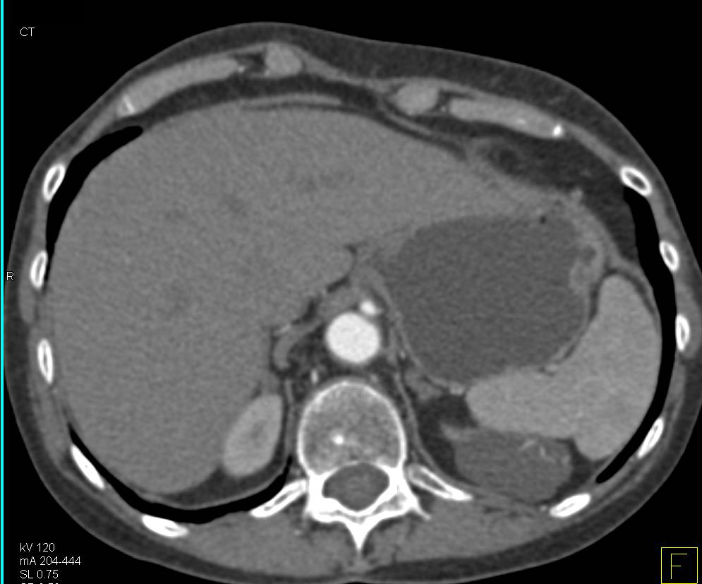 Bosniak Type II Cyst Left Kidney - CTisus CT Scan
