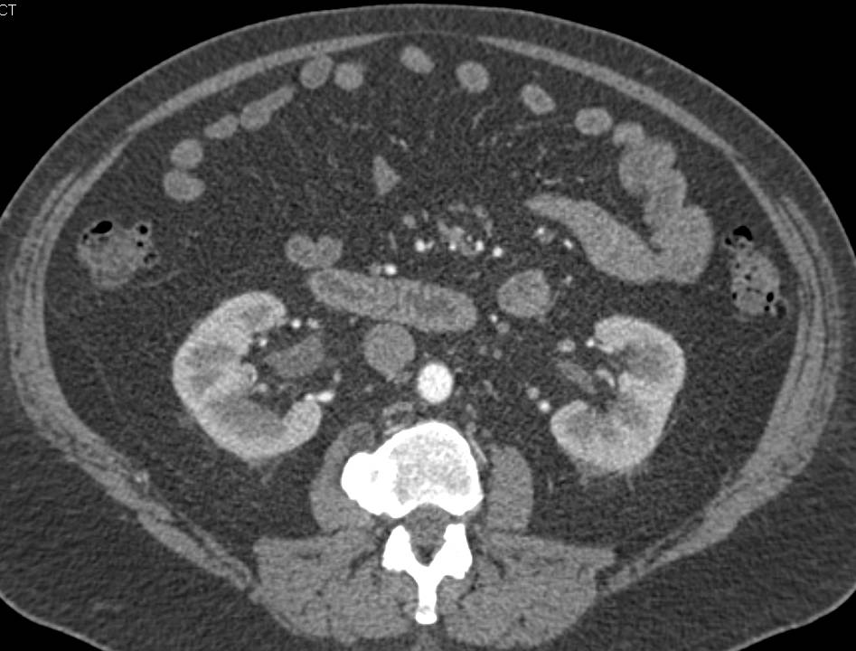 Right Sided Hydronephrosis due to Obstructing Stone in Ureter - CTisus CT Scan