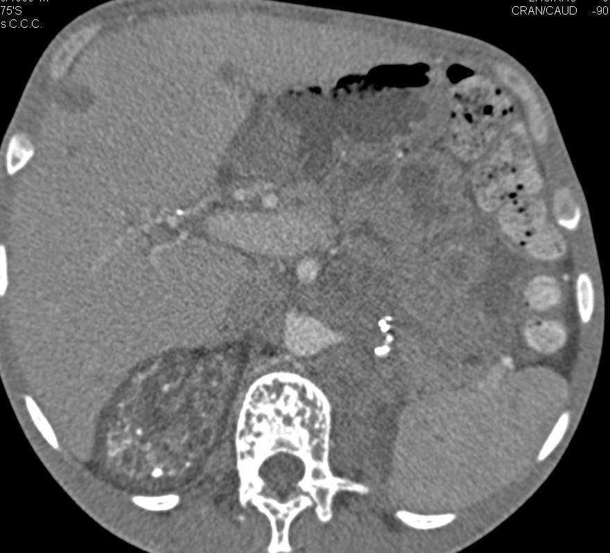 End Stage Renal Disease with Renal Osteodystrophy Best Seen in L-Spine - CTisus CT Scan
