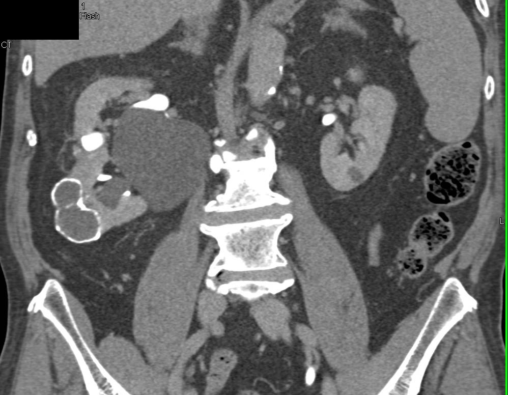 Bosniak 2F Calcified Cyst Right Kidney in Multiple Phases - CTisus CT Scan