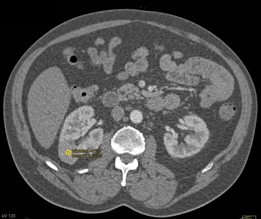 Papillary Renal Cell Carcinoma - CTisus CT Scan