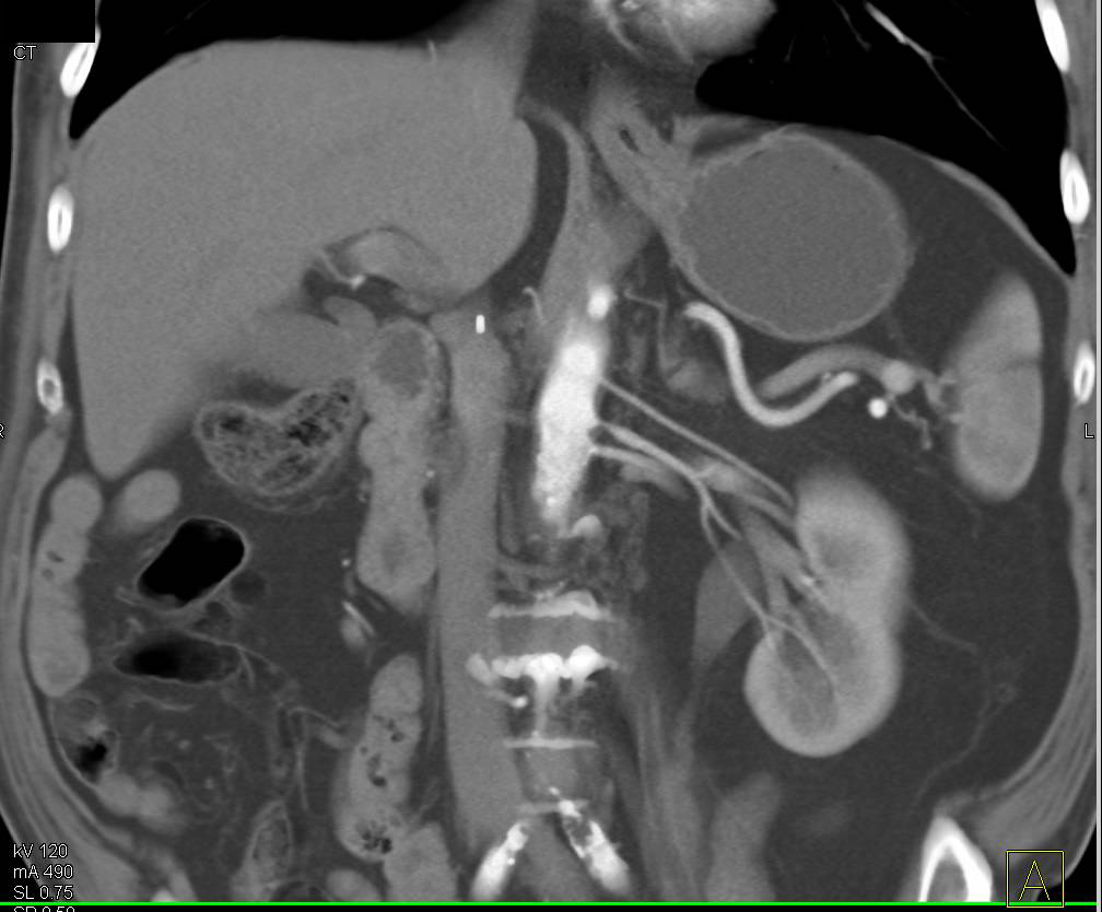 Three Left Renal Arteries with Stenosis in Middle Artery - CTisus CT Scan