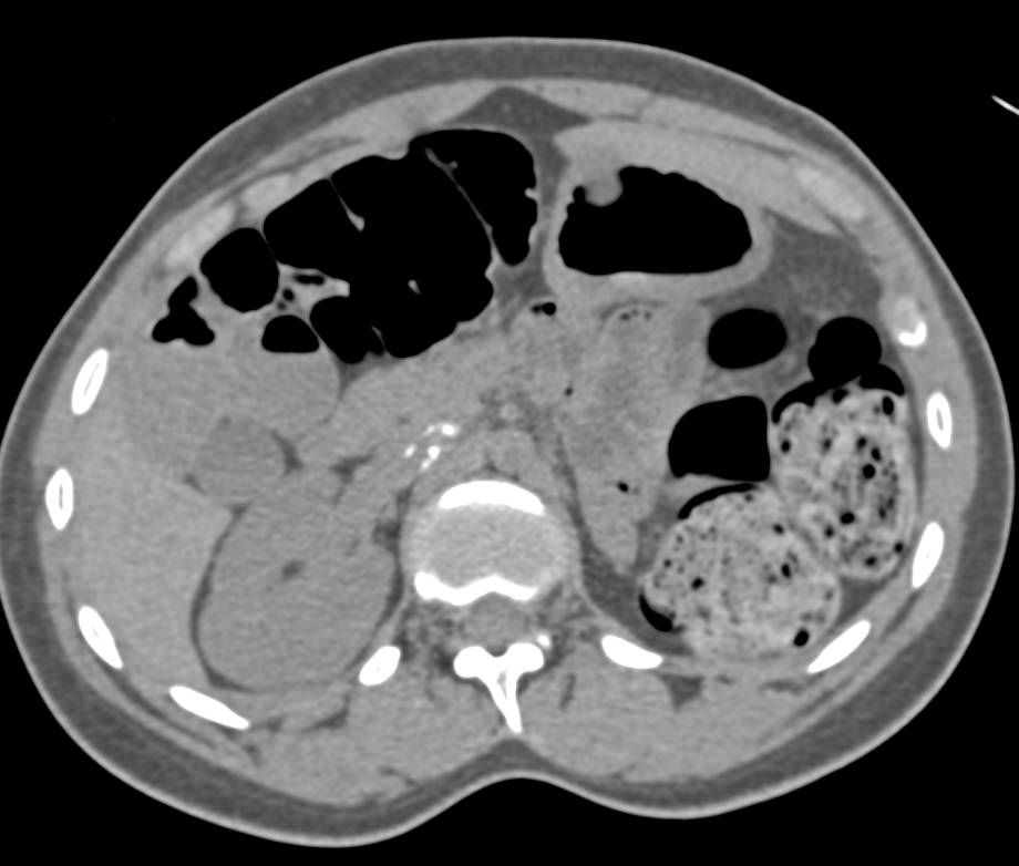 Reimplanted Right Renal Artery to SMA - CTisus CT Scan