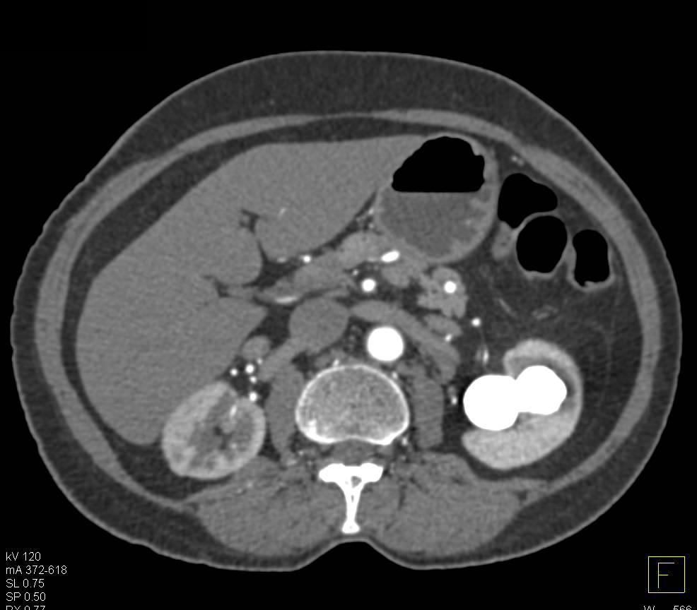 Staghorn Calculi with Form Of XGP (xanthogranulomatous pyelonephritis) - CTisus CT Scan