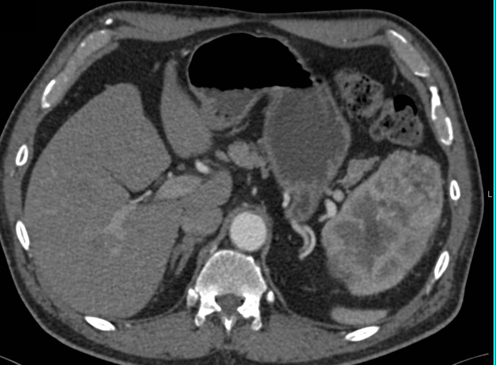 Large Simple Left Renal Cyst - CTisus CT Scan