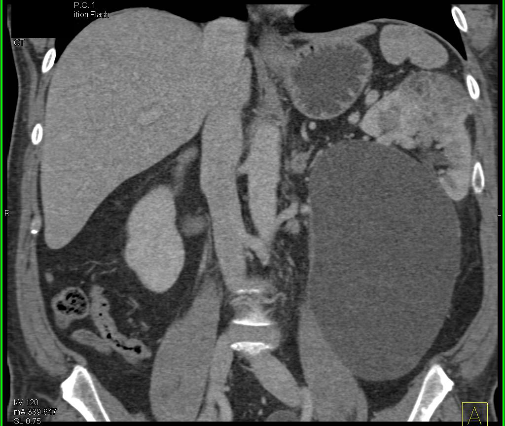 Duplicated Lower Pole Collecting System on the Left with Dilated Left Ureter and Aberrant Insertion into the Bladder - CTisus CT Scan