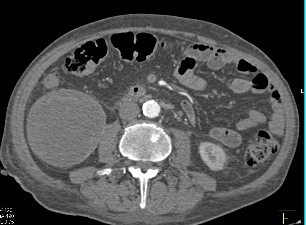 Cystic Right Renal Cell Carcinoma - CTisus CT Scan