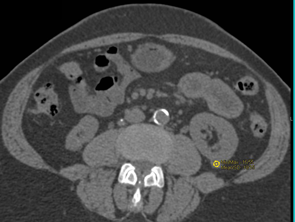 Renal Cell Carcinoma and High Density Renal Cyst in Left Kidney - CTisus CT Scan