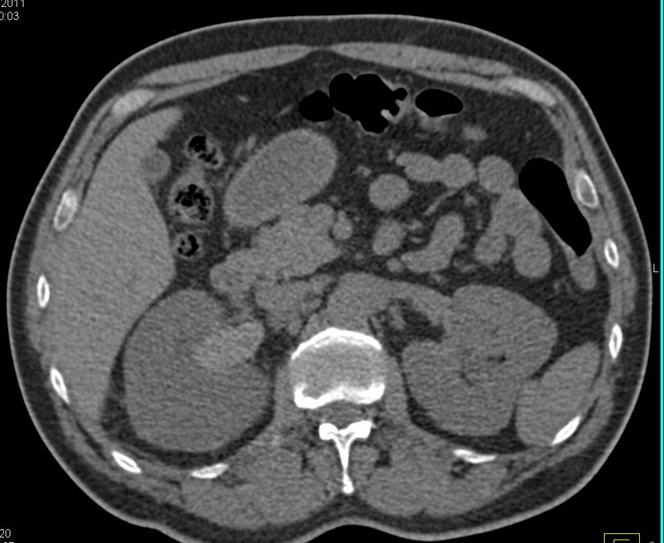 Perirenal Bleed and Blood in Right Renal Pelvis Following Trauma - CTisus CT Scan