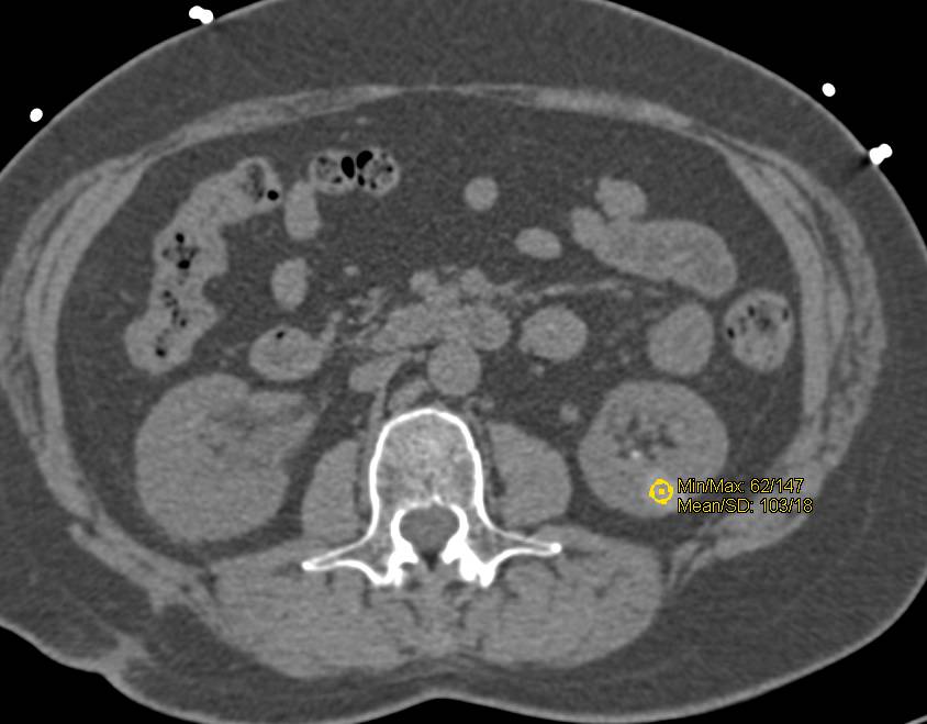 High Density Renal Cysts - CTisus CT Scan