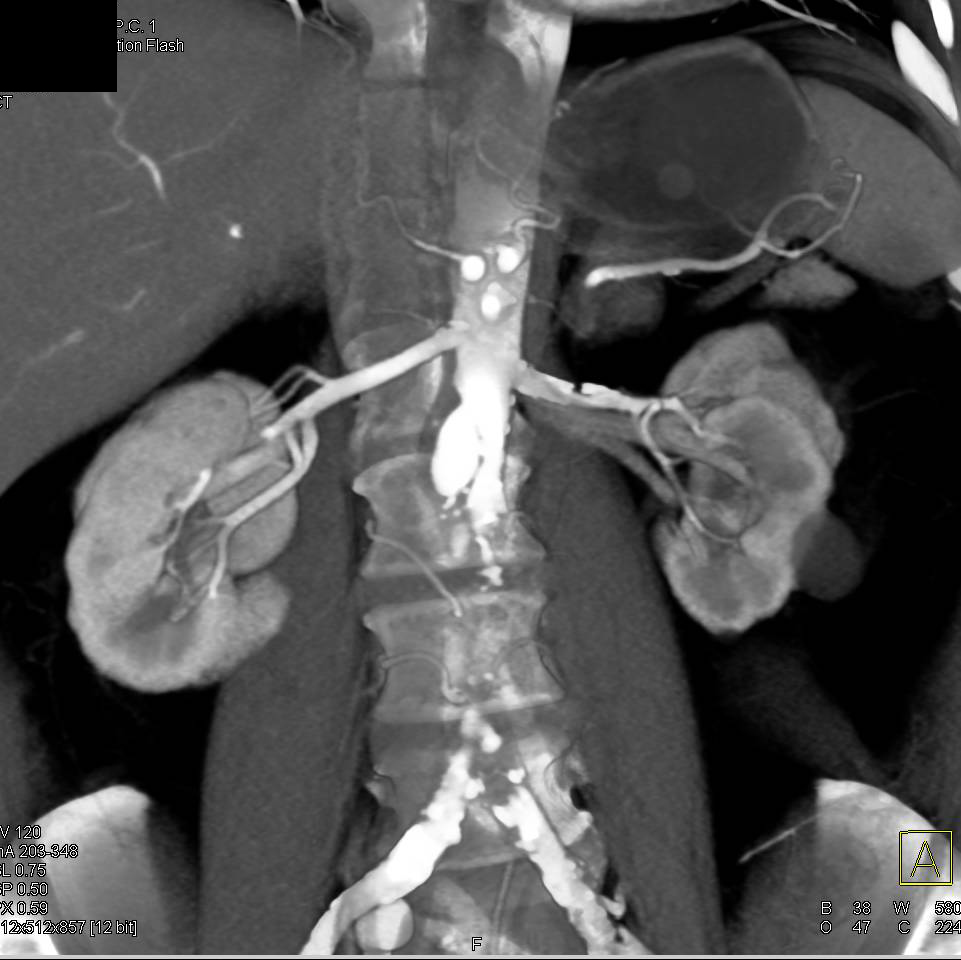 Patent Stent in Left Renal Artery but Plaque Still Present Beyond the Stent - CTisus CT Scan