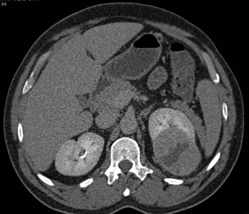 Papillary Renal Cell Carcinoma - CTisus CT Scan