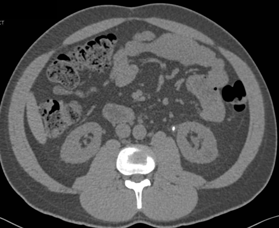 Obstructing Stone in the Proximal Left Ureter - CTisus CT Scan