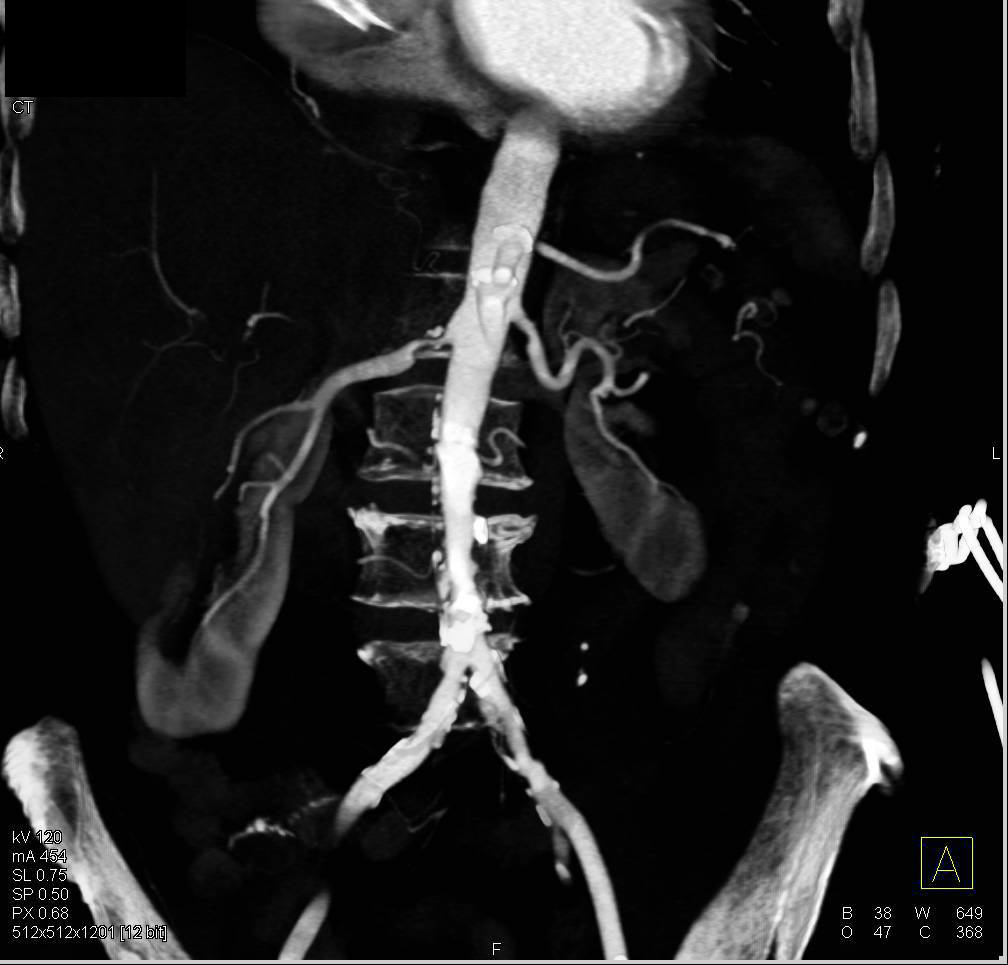 Right Renal Artery Stenosis - CTisus CT Scan
