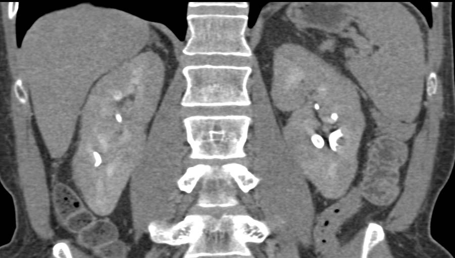 Renal Infarcts in a Patient with Autoimmune Pancreatitis - CTisus CT Scan