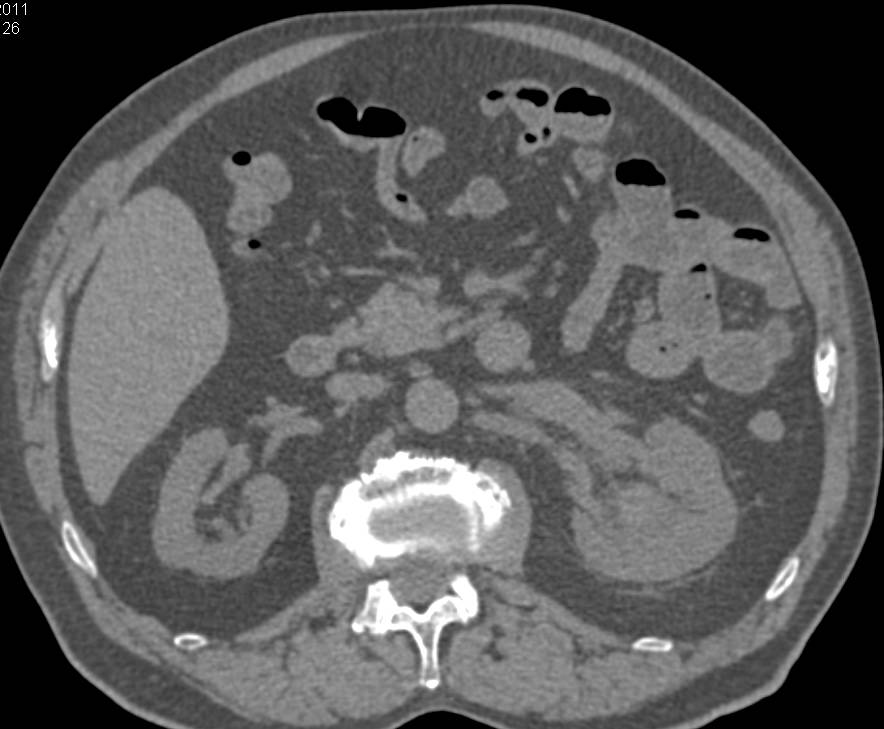 Transitional Cell Carcinoma Left Upper Pole Calyces - CTisus CT Scan