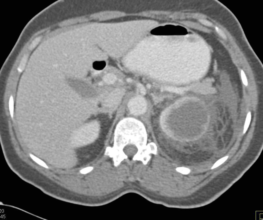 Pyonephrosis Left Kidney due to Obstructing Stone in Ureter - CTisus CT Scan