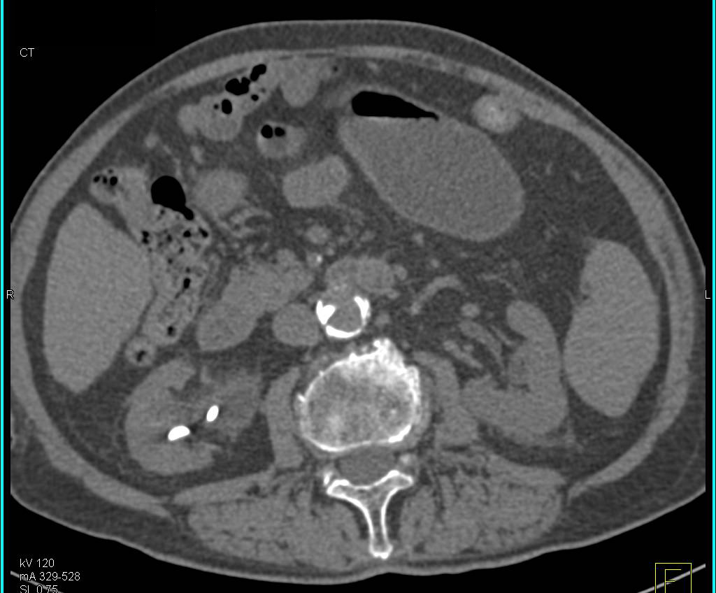 Right Ureteropelvic Junction (UPJ) with Stent in Place - CTisus CT Scan