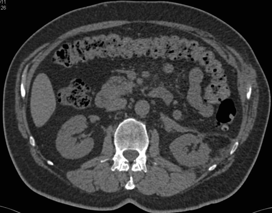 Post Cryo-Ablation Changes Left Kidney - CTisus CT Scan