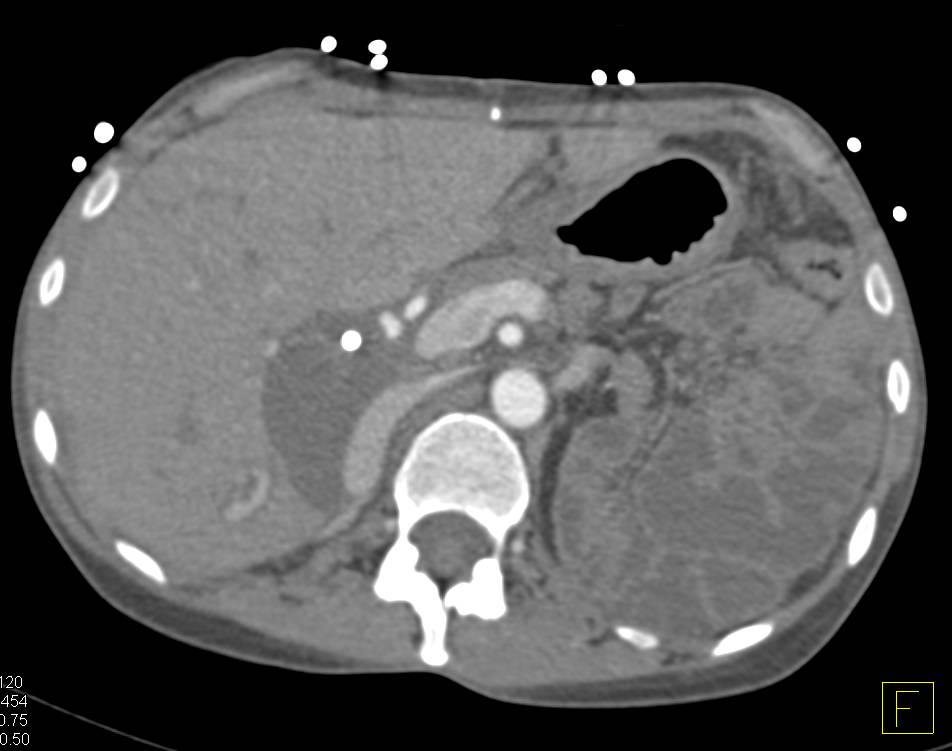 Bilateral Nephrectomies with a Renal Transplant. Dilated Small Bowel Seen. - CTisus CT Scan