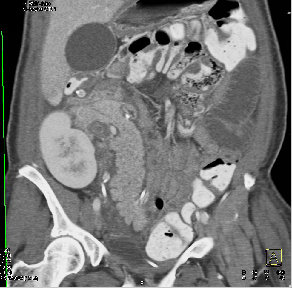 Pancreatic Transplant in the Right Lower Quadrant - CTisus CT Scan
