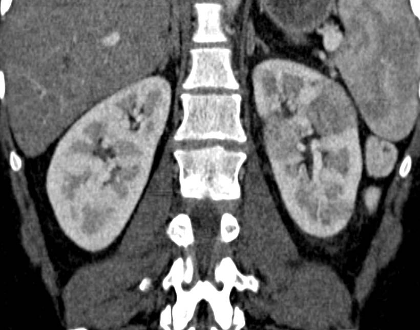 Acute Pyelonephritis Left Kidney with Patchy Enhancement - CTisus CT Scan