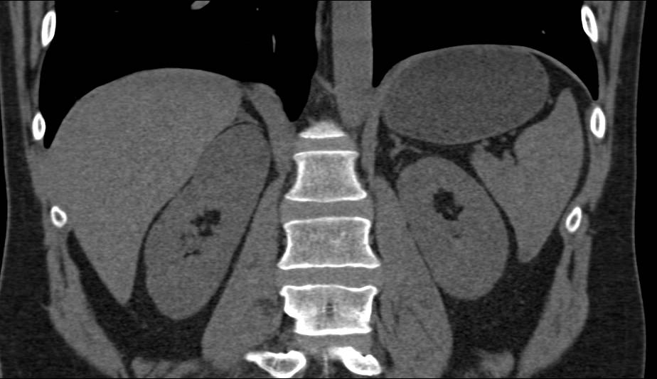 Bosniak II Cyst Right Kidney - CTisus CT Scan